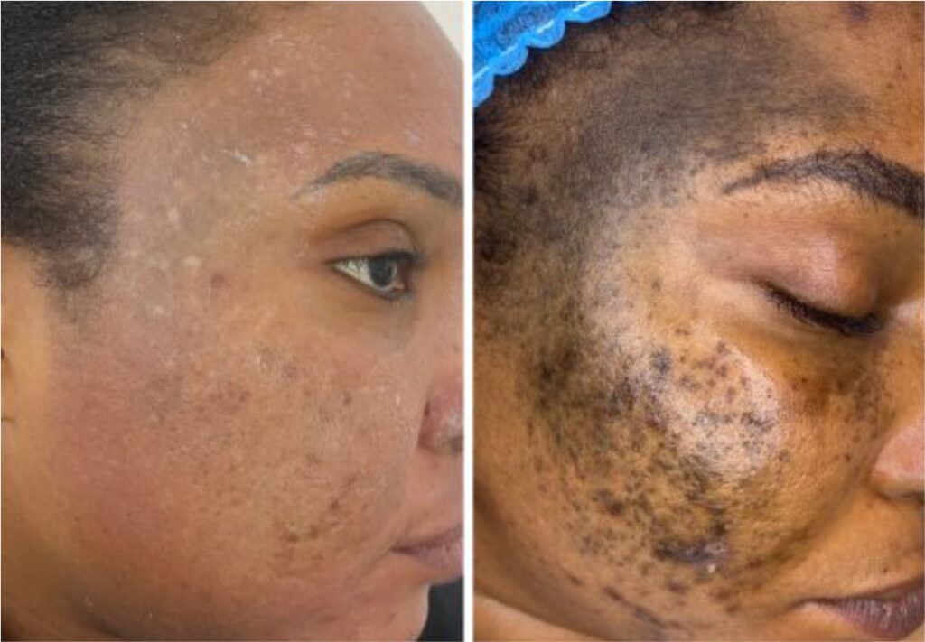 Nevus of Ota abuja