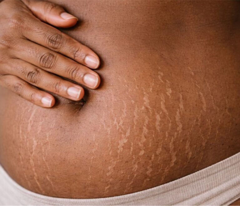 Laser Stretch mark Treatment