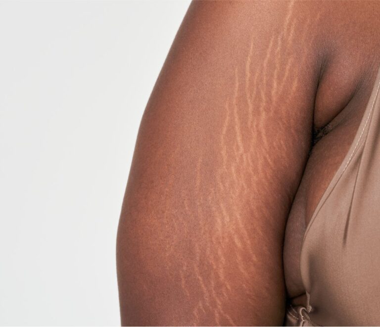 Stretch Marks