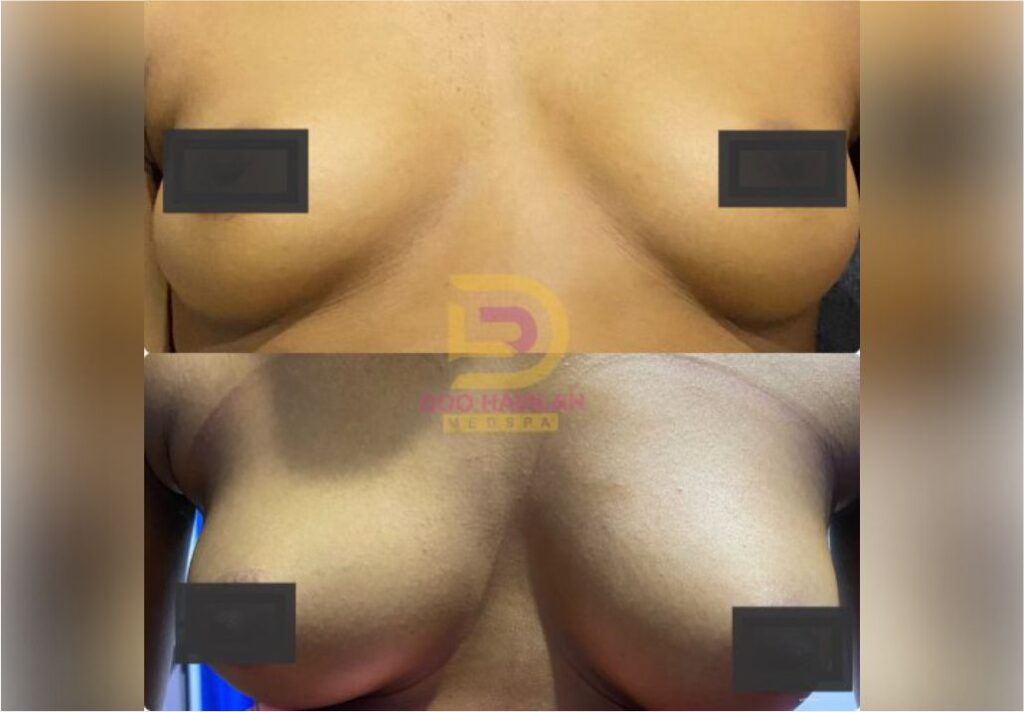 breast fillers