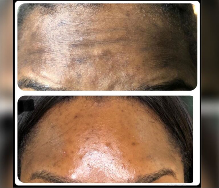 Injectables (Fillers & Botox)