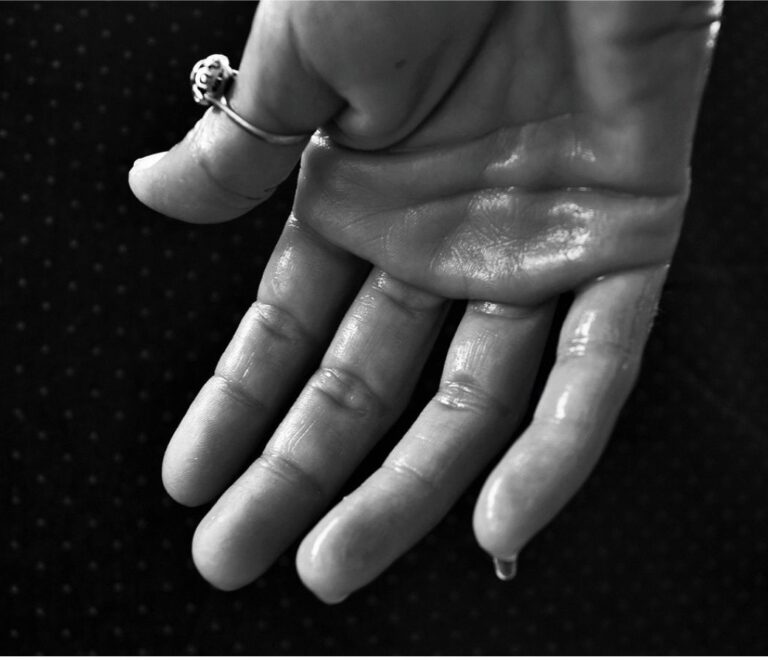 Hyperhidrosis