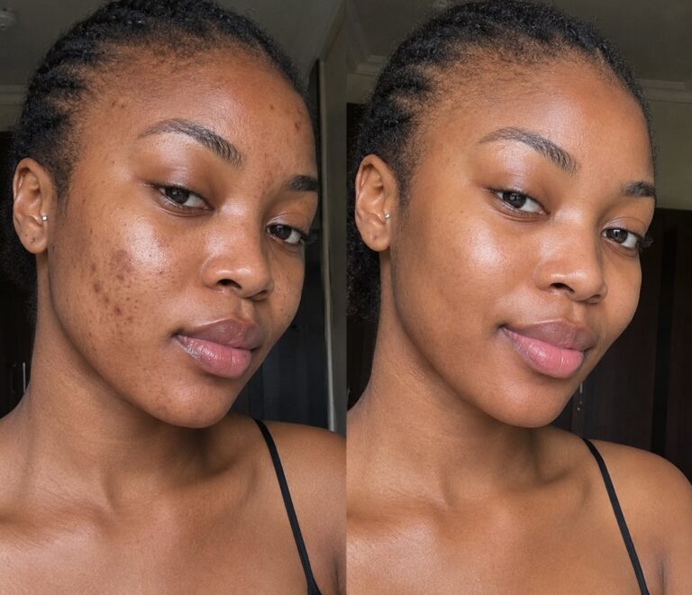Best Skincare Products for Dark Spots on Melanin-Rich Skin in Nigeria