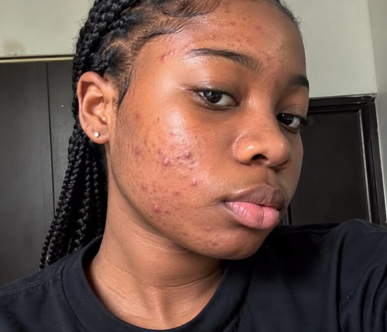 Teenage Acne Treatment: When Should Your Teen See a Dermatologist?